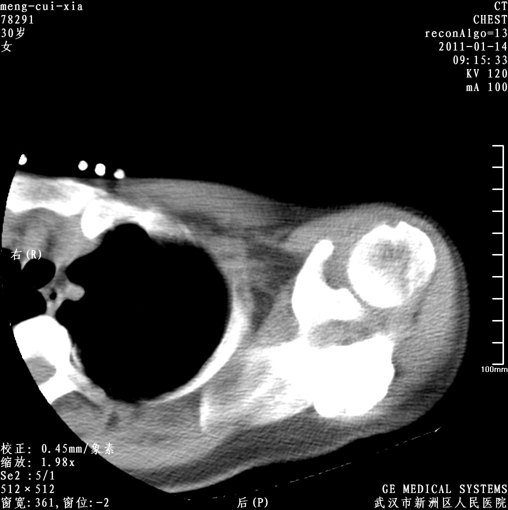 ct31439:女,30岁左肩部包块 请各位专家诊断,很少见.