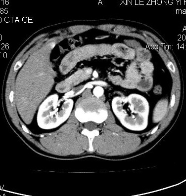 ct32170:肾动脉cta