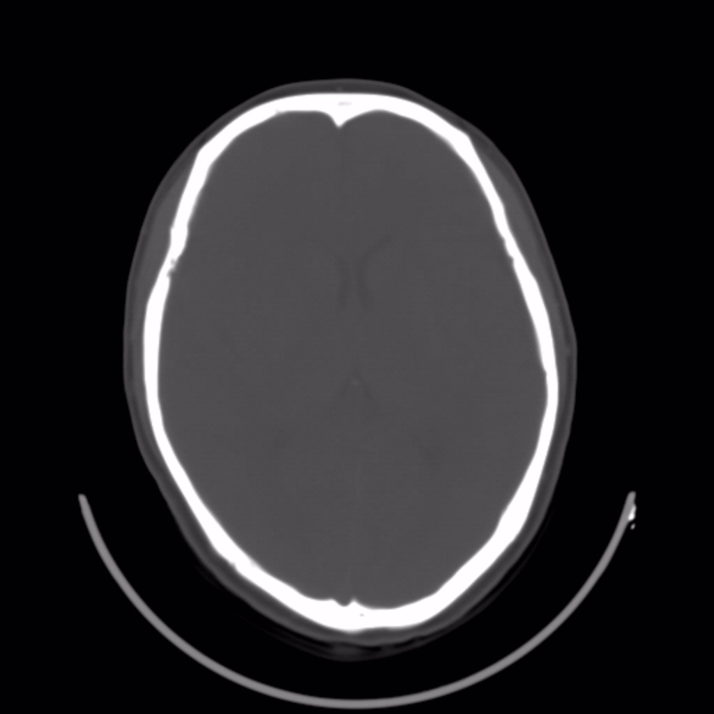 ct31906颅骨骨瘤