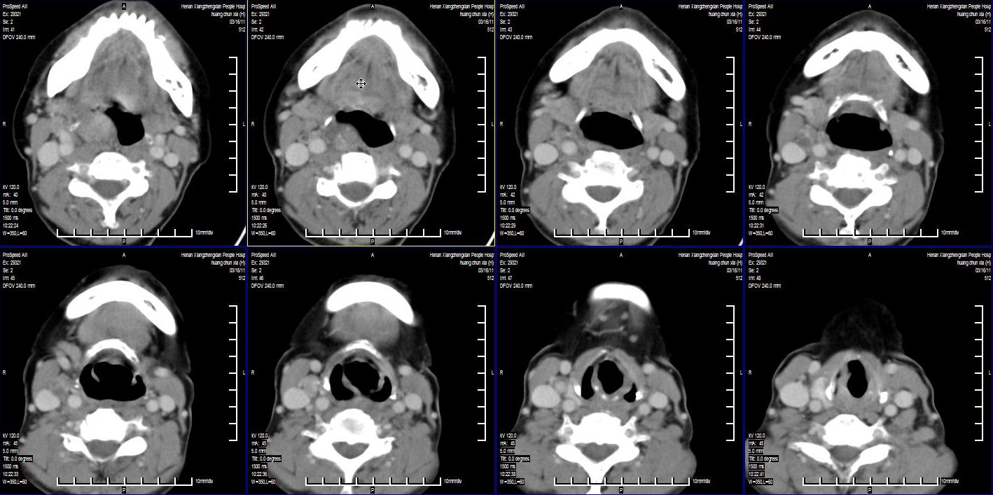 ct32597:右侧咽旁间隙肿块! 请会诊!