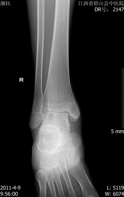 ct32991:右踝关节病变,请分析.