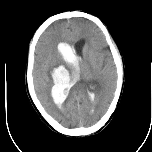 ct33066:男,60岁,有高血压史,高血压性脑出血.