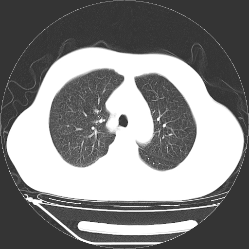 ct33356:男,72岁,胸部ct体检发现双肺内多发微小结节