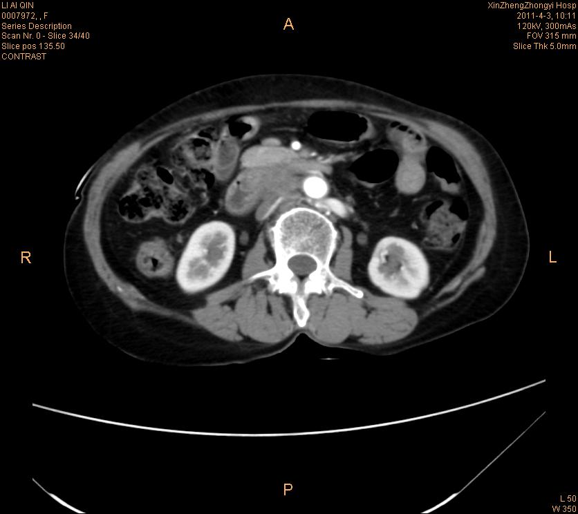 ct32888:胆总管扩张,胆总管中下段占位?腹部增强