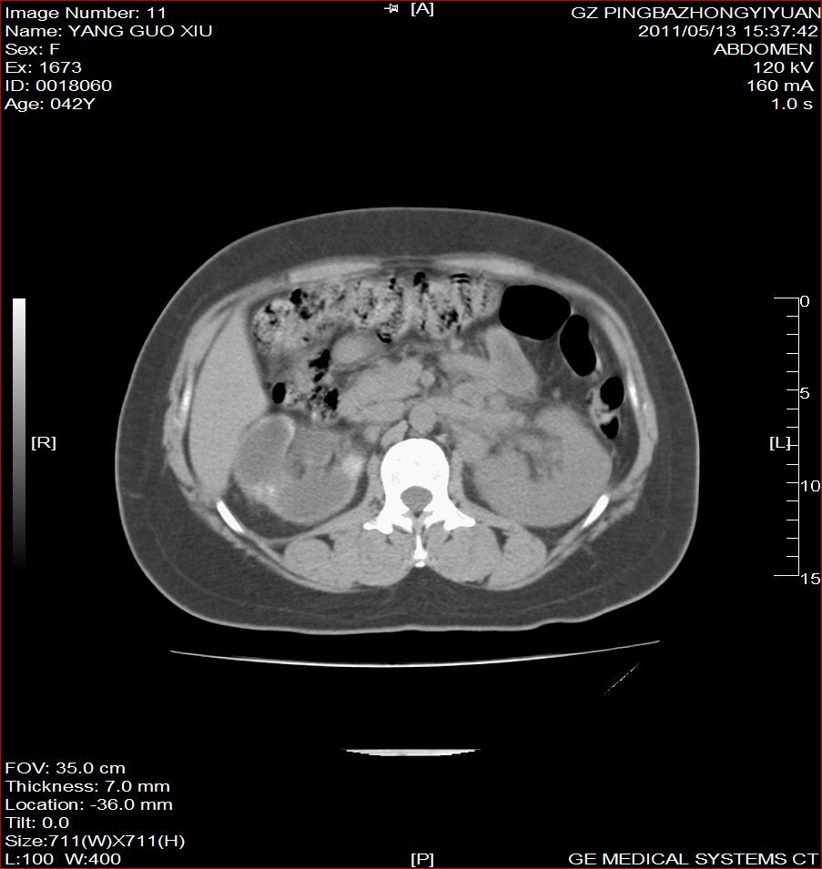ct33685右肾结核