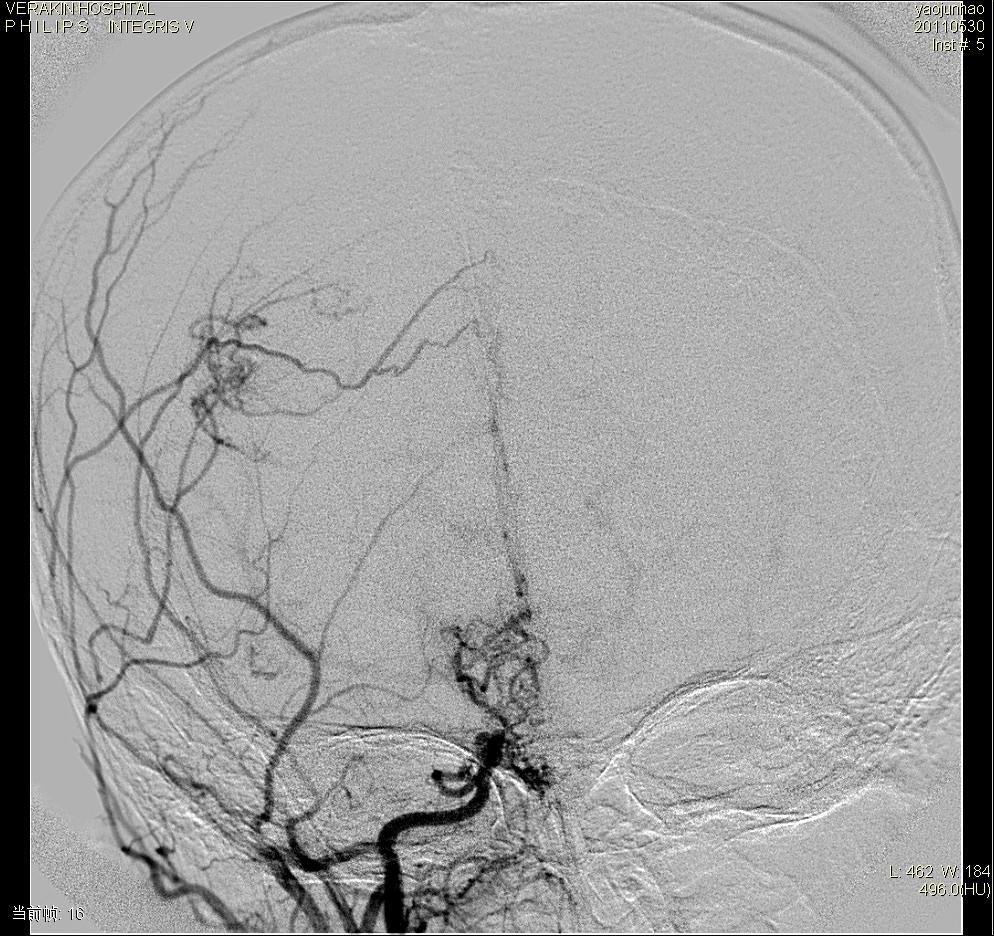 dsa0162:脑血管畸形