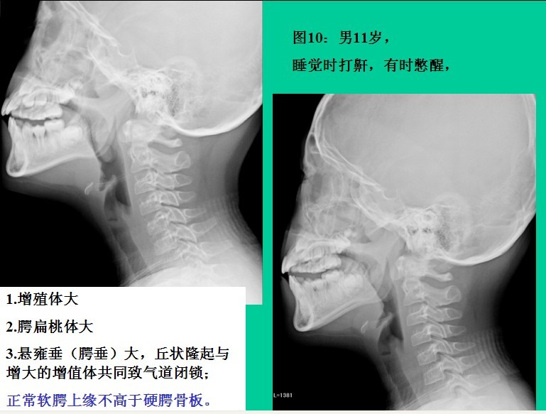 腺样体肥大的诊断标准是什么?