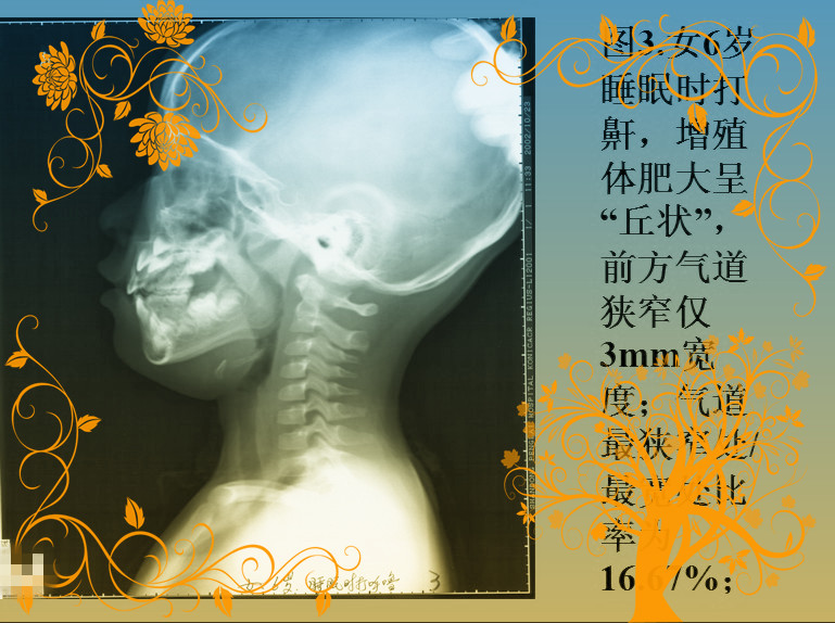腺样体肥大的诊断标准是什么?