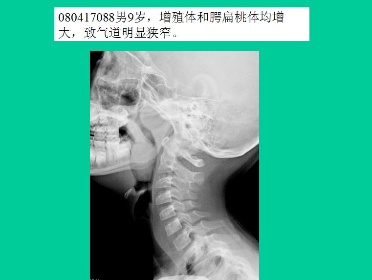 腺样体肥大的诊断标准是什么?