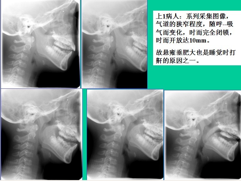 腺样体肥大的诊断标准是什么?