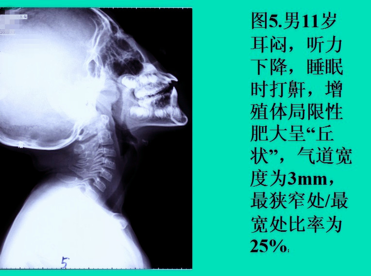 腺样体肥大的诊断标准是什么?