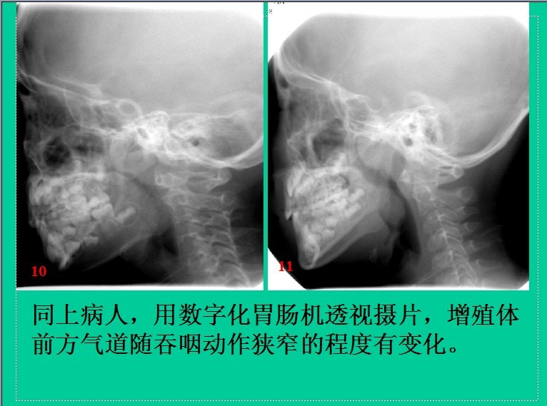 腺样体肥大的诊断标准是什么?
