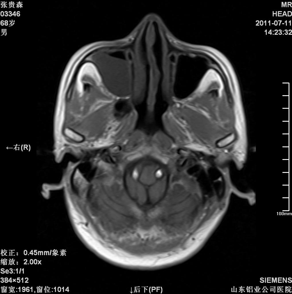 mri4054:右侧cpa区占位,考虑听神经瘤