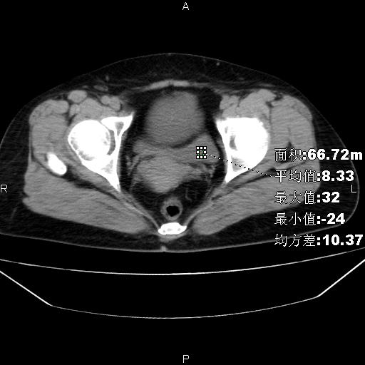 ct34641:老年女性,这个膀胱有问题么?