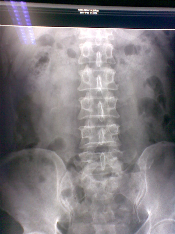 x9819:患者男47岁,腹部胀痛 - x线病例讨论 医影在线