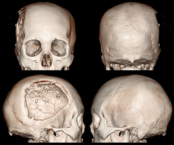 cl2525:广东同江医院的病例:颅骨修补术后15年,颅骨畸形1
