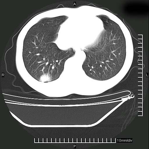 ct35634:胸部增强:男性 40岁 右下肺结节影