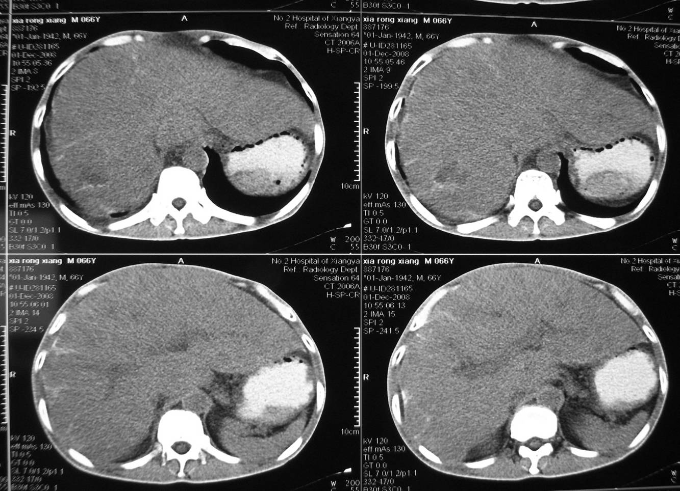 ct35592:男,66岁, 肝脏病变,请分析