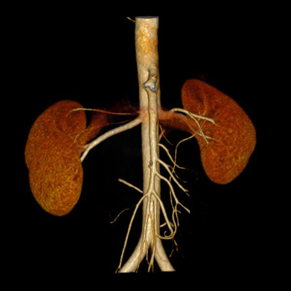 new0545:肾动脉cta,广东同江医院的病例