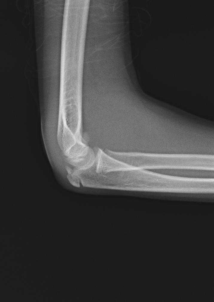 ped4091:m,13y,右侧肘关节外伤一天.