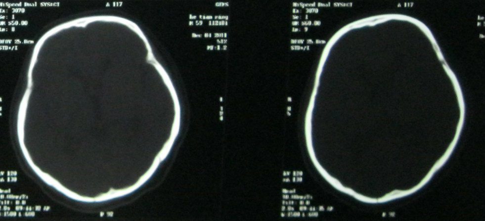 ct36691枕骨骨折吗