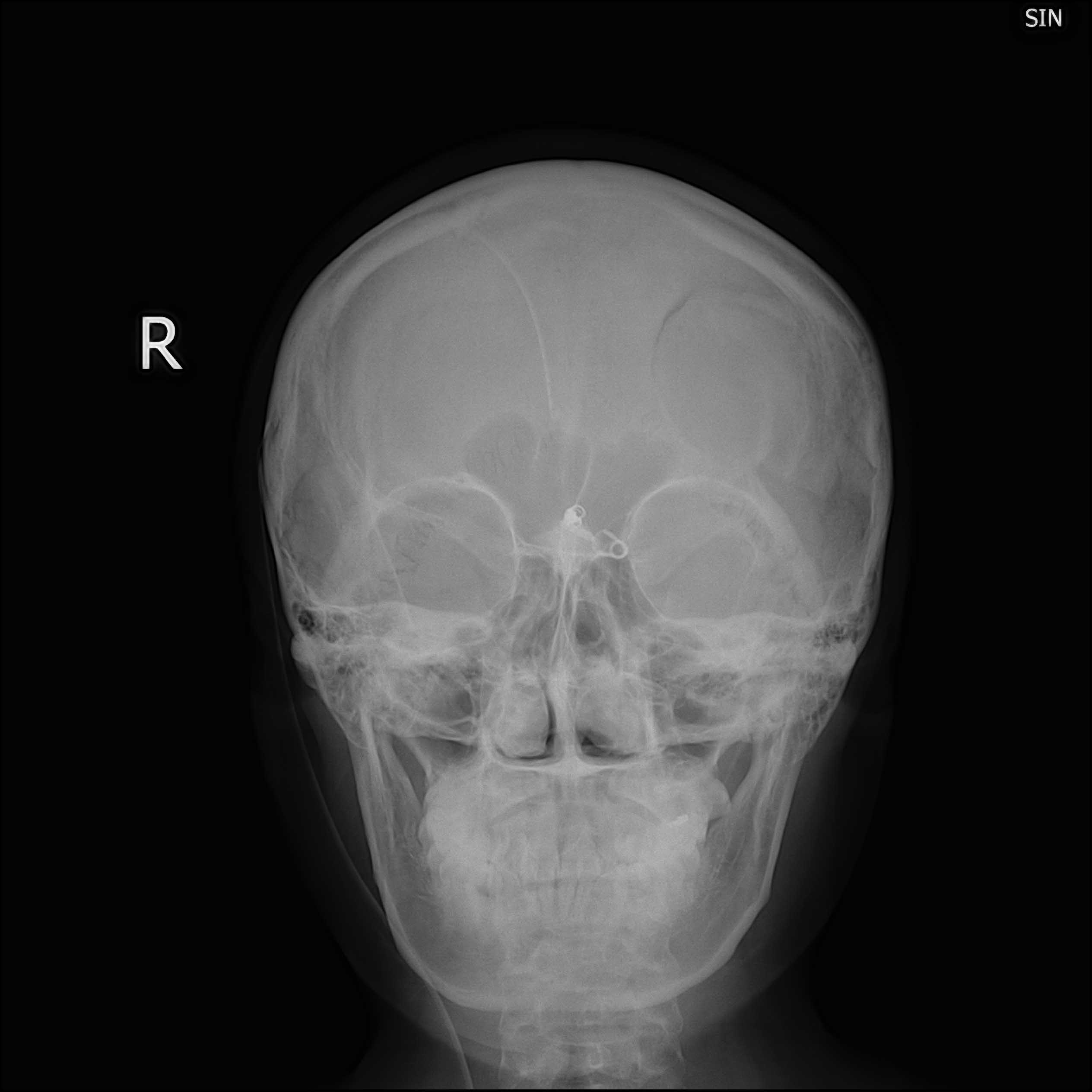 x10576:头部到腹部x片正侧位,特殊疑难患者,大家帮瞧瞧