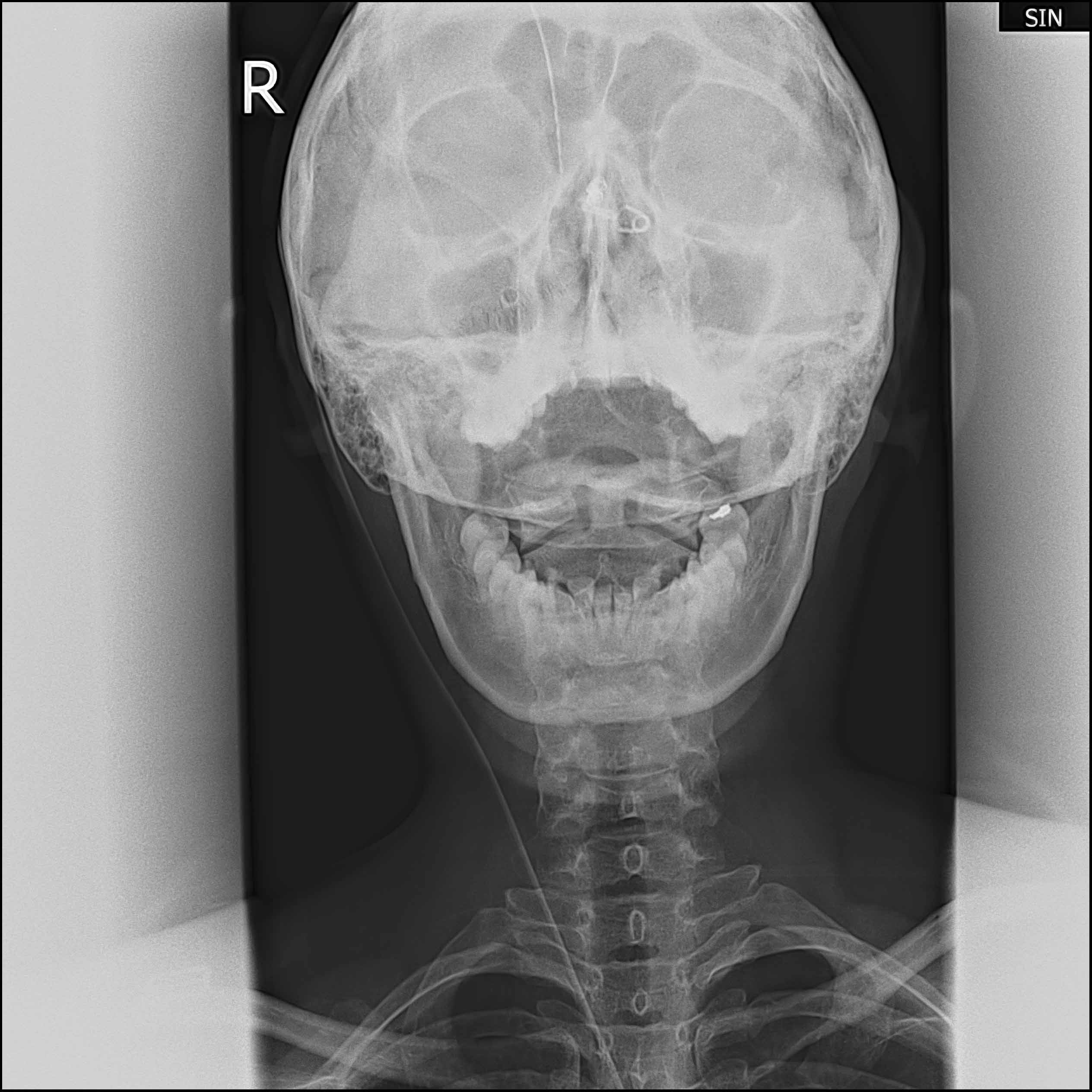 x10576:头部到腹部x片正侧位,特殊疑难患者,大家帮瞧瞧