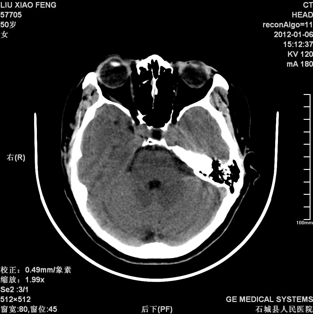 ct37056:右枕骨压迹,蛛网膜颗粒压迹?