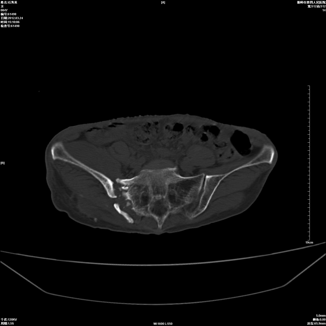 ct37939:86岁 女性 右侧骶髂关节骨质破坏请老师帮忙诊断