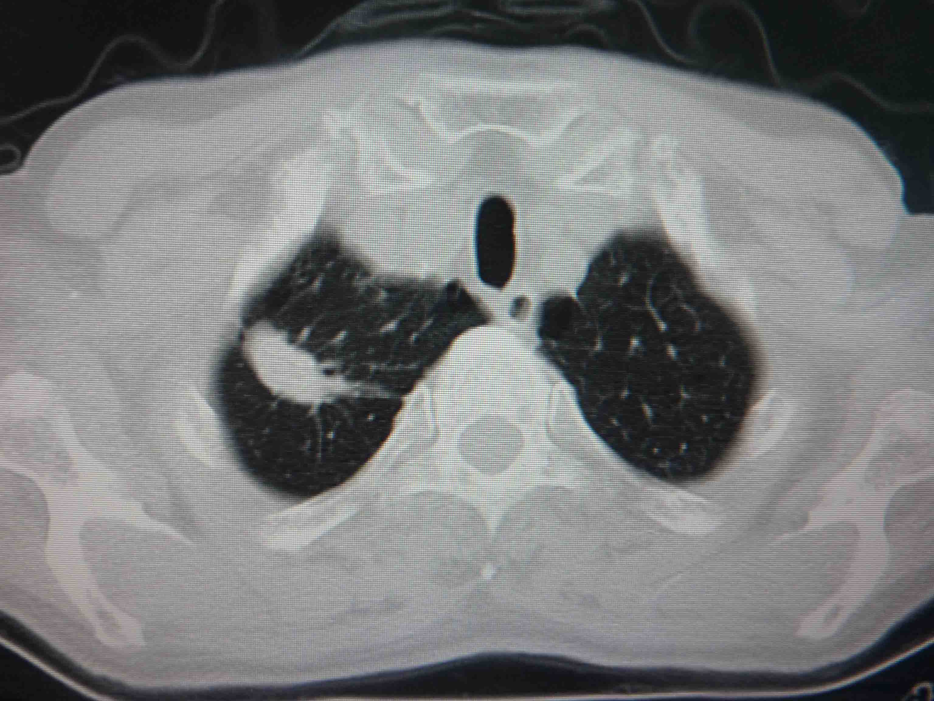 肺部 CT 阅片技巧剖析 障眼法再也不怕了