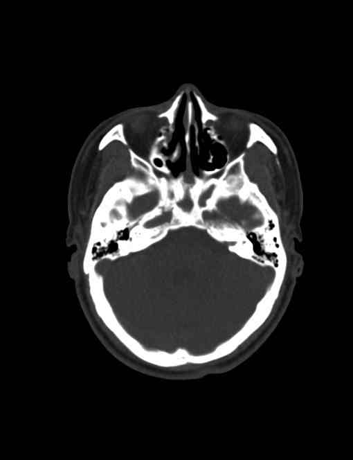 ct38191:男,42岁,头痛1个月,视物模糊3天.鞍区ct