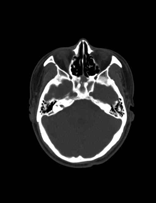 ct38191:男,42岁,头痛1个月,视物模糊3天.鞍区ct