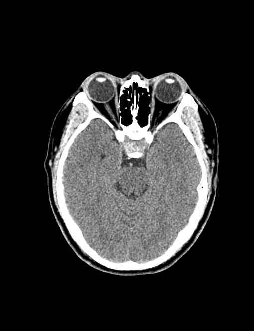 ct38191:男,42岁,头痛1个月,视物模糊3天.鞍区ct