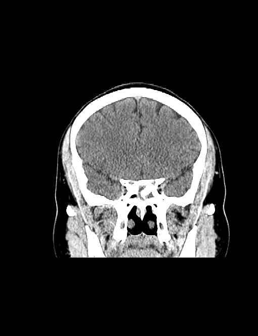 ct38191:男,42岁,头痛1个月,视物模糊3天.鞍区ct