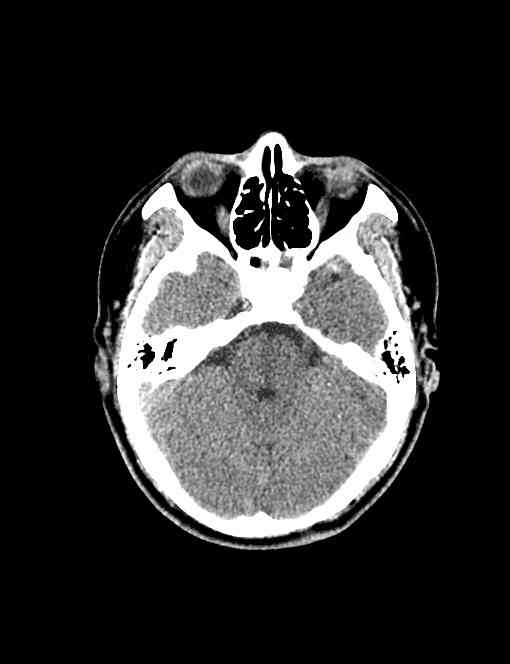 ct38191:男,42岁,头痛1个月,视物模糊3天.鞍区ct