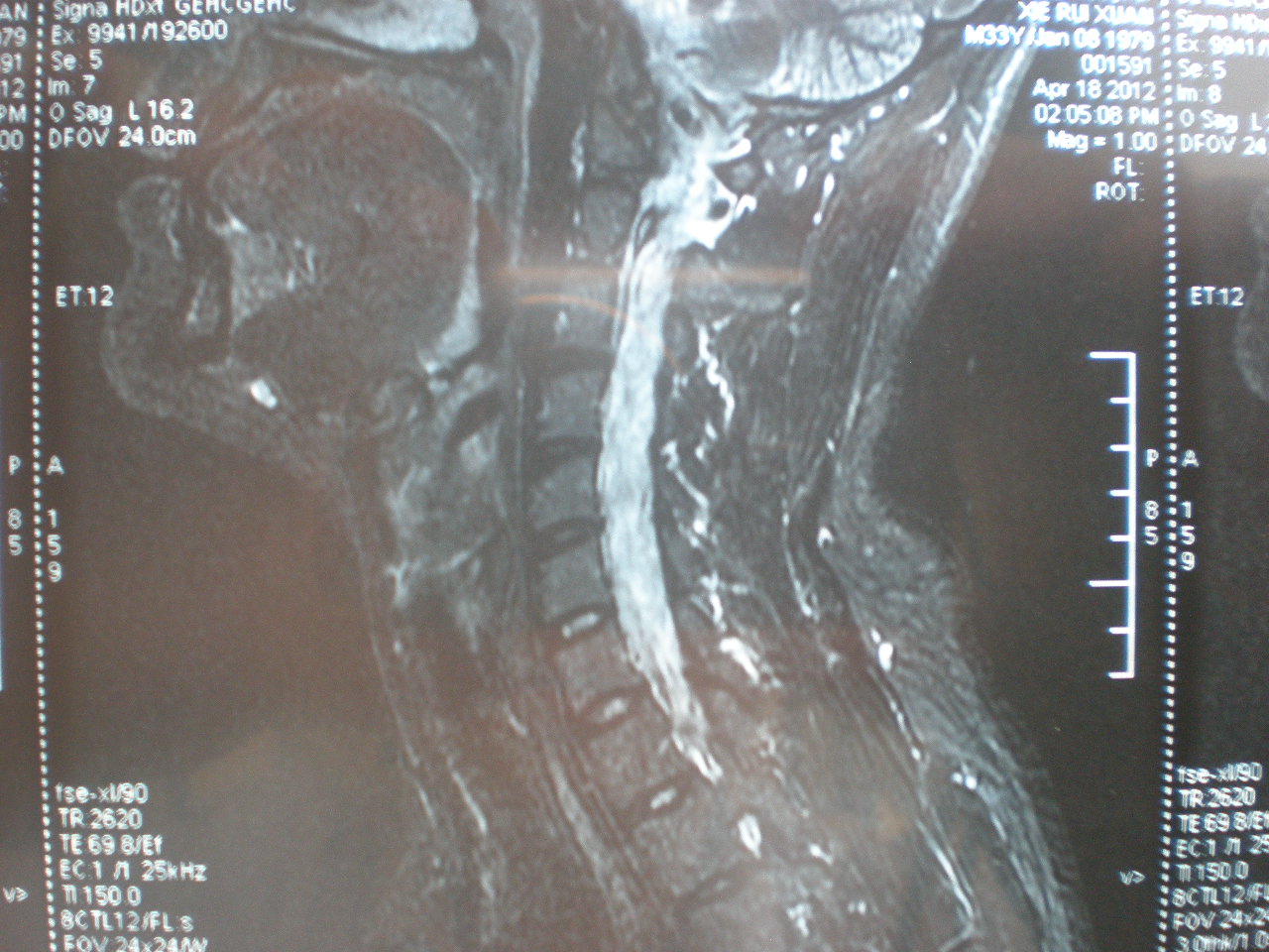 mri4970请帮忙分析颈椎mri