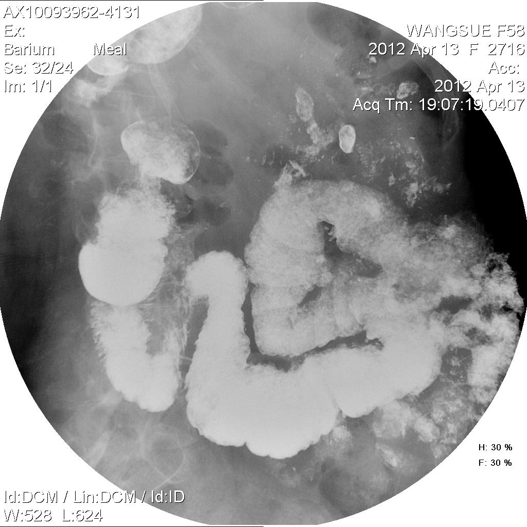 x11074:女,58岁,乙状结肠ca术后,全消化道造影