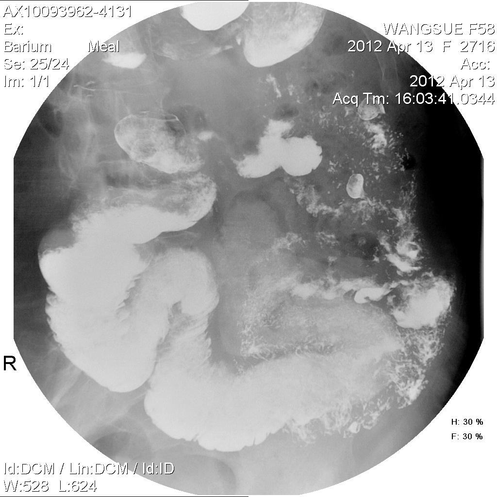 x11074:女,58岁,乙状结肠ca术后,全消化道造影