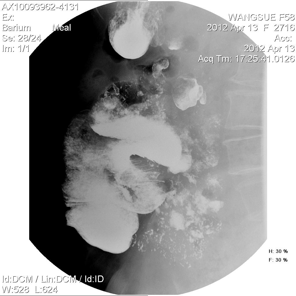 x11074:女,58岁,乙状结肠ca术后,全消化道造影