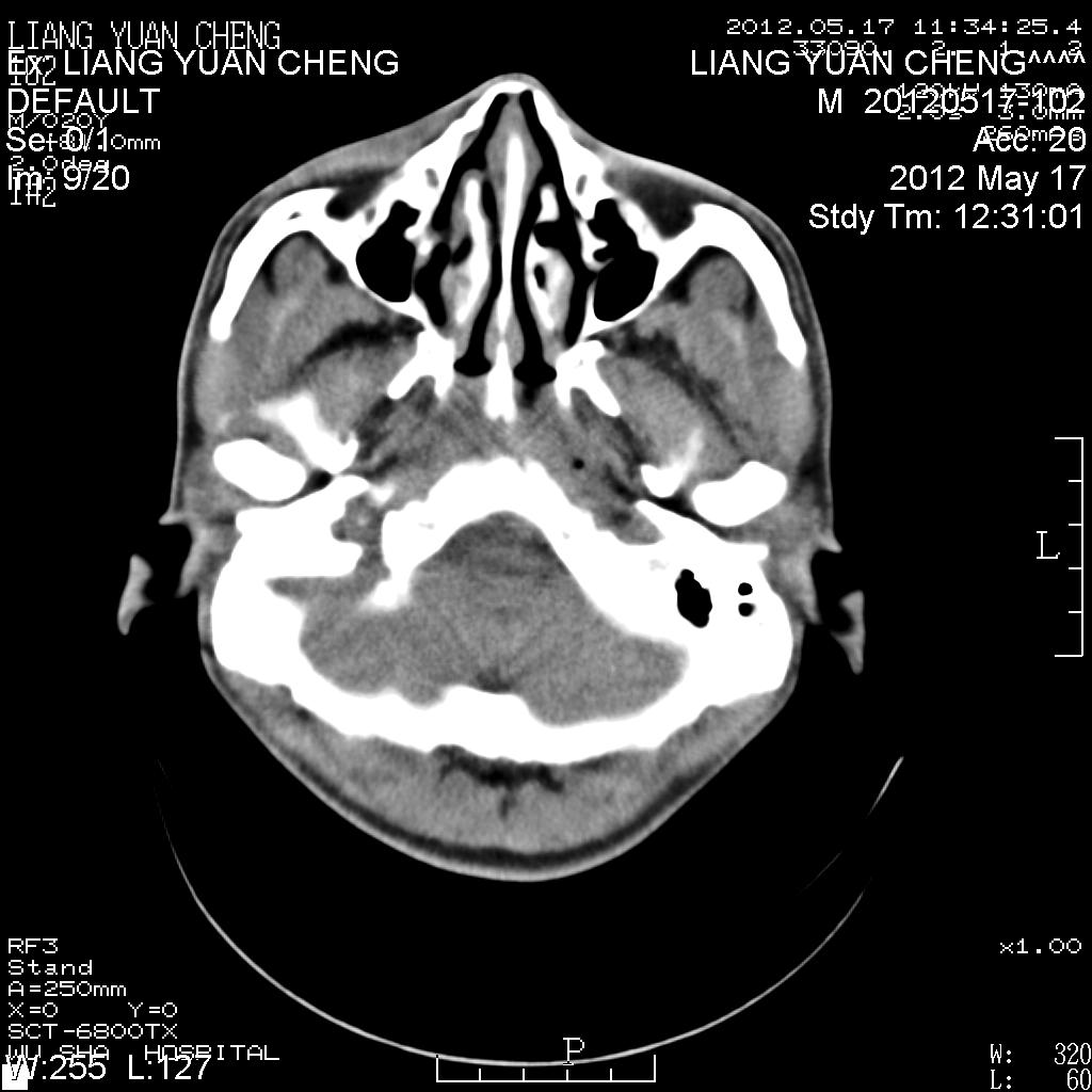 ct38674鼻骨骨折吗