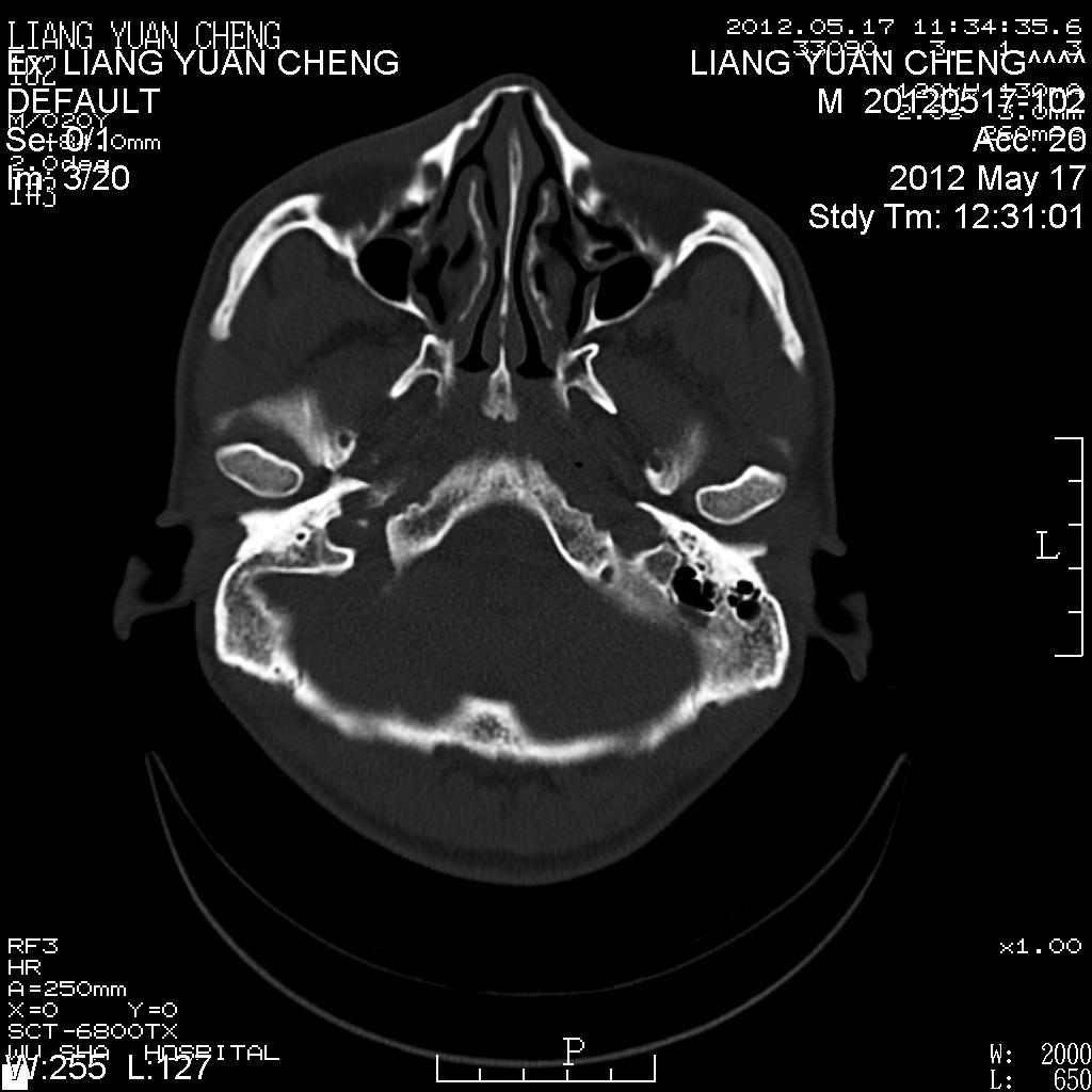 ct38674鼻骨骨折吗