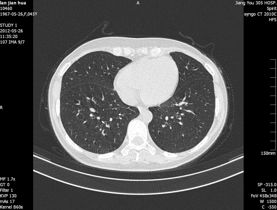 ct38787:女性,45y,肺部结节(近期出结果)
