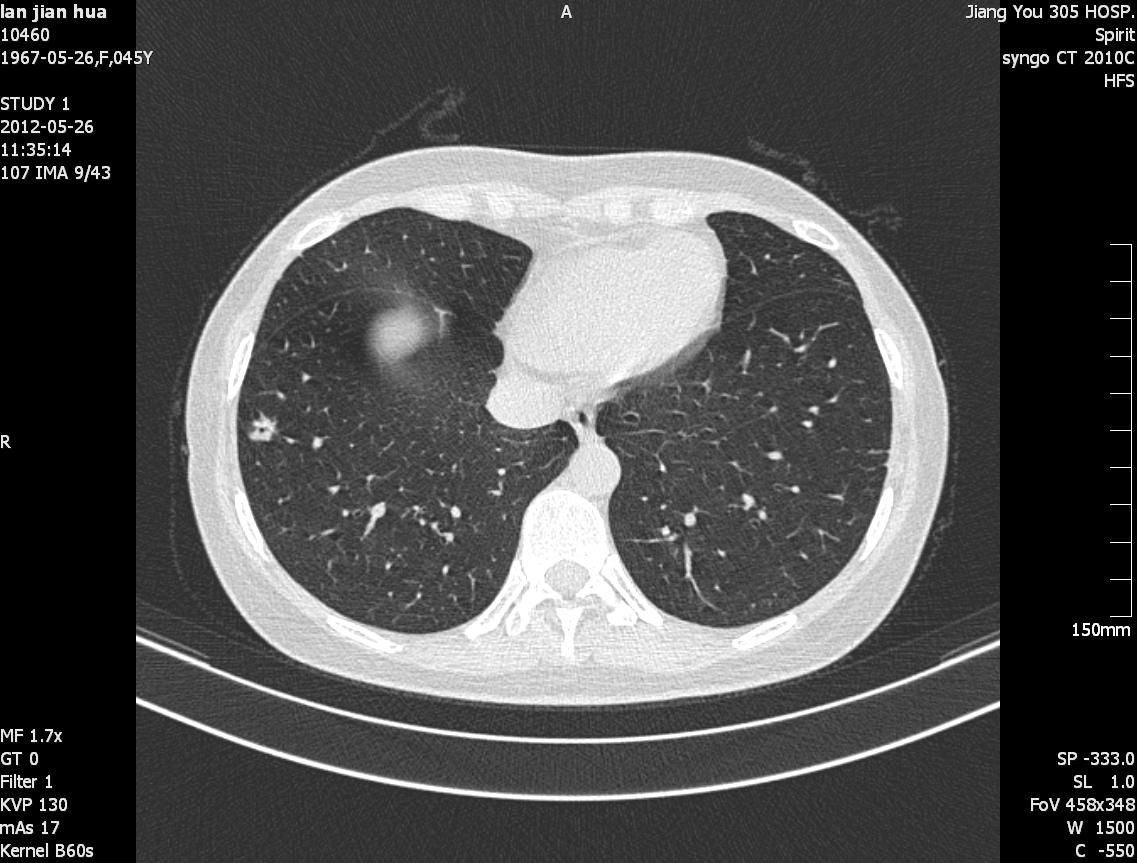 ct38787:女性,45y,肺部结节(近期出结果)