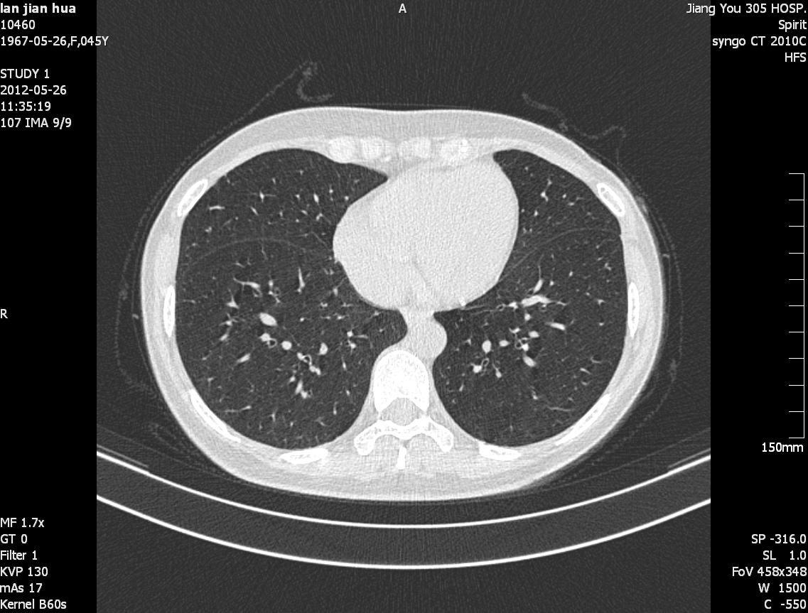 ct38787:女性,45y,肺部结节(近期出结果)
