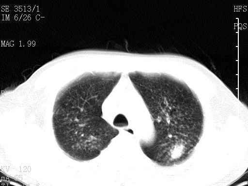 ct38648两侧矽肺合并结核吗