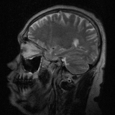 mri5029:男,40,是否空泡蝶鞍?囊肿?已传ct