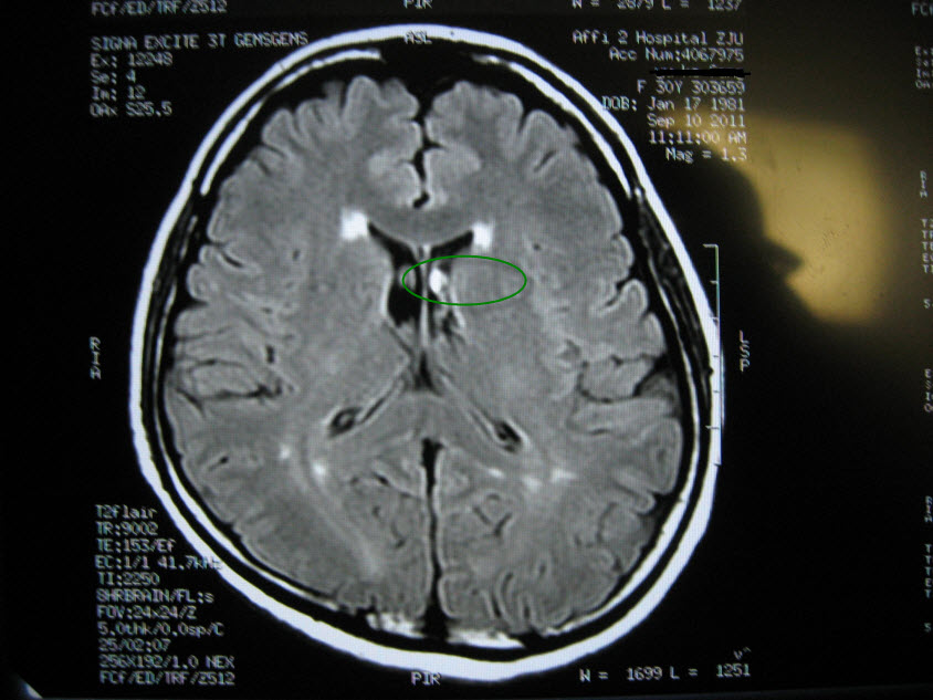 mri5013缺血灶还是其他病变在10楼又上传了更多图像