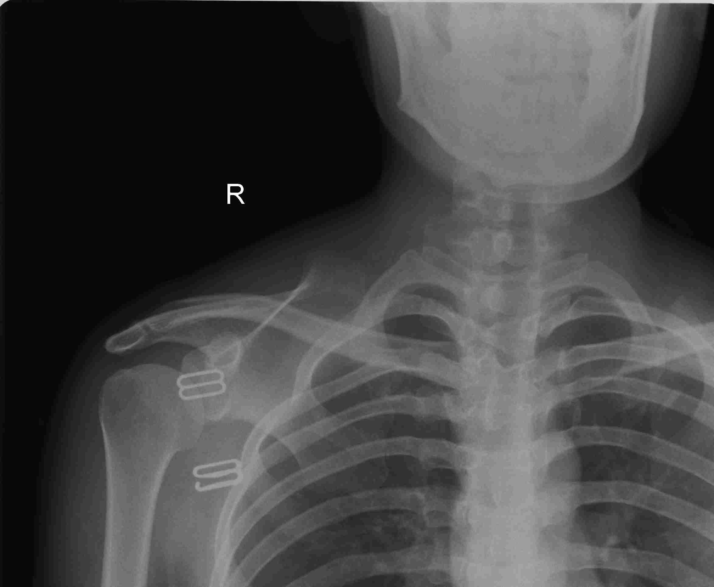 x11164:右肩胛骨病变,求指点