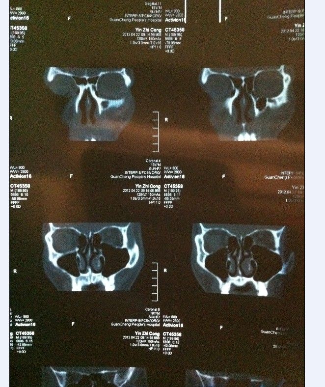 ct39022:帮忙看看ct鼻骨