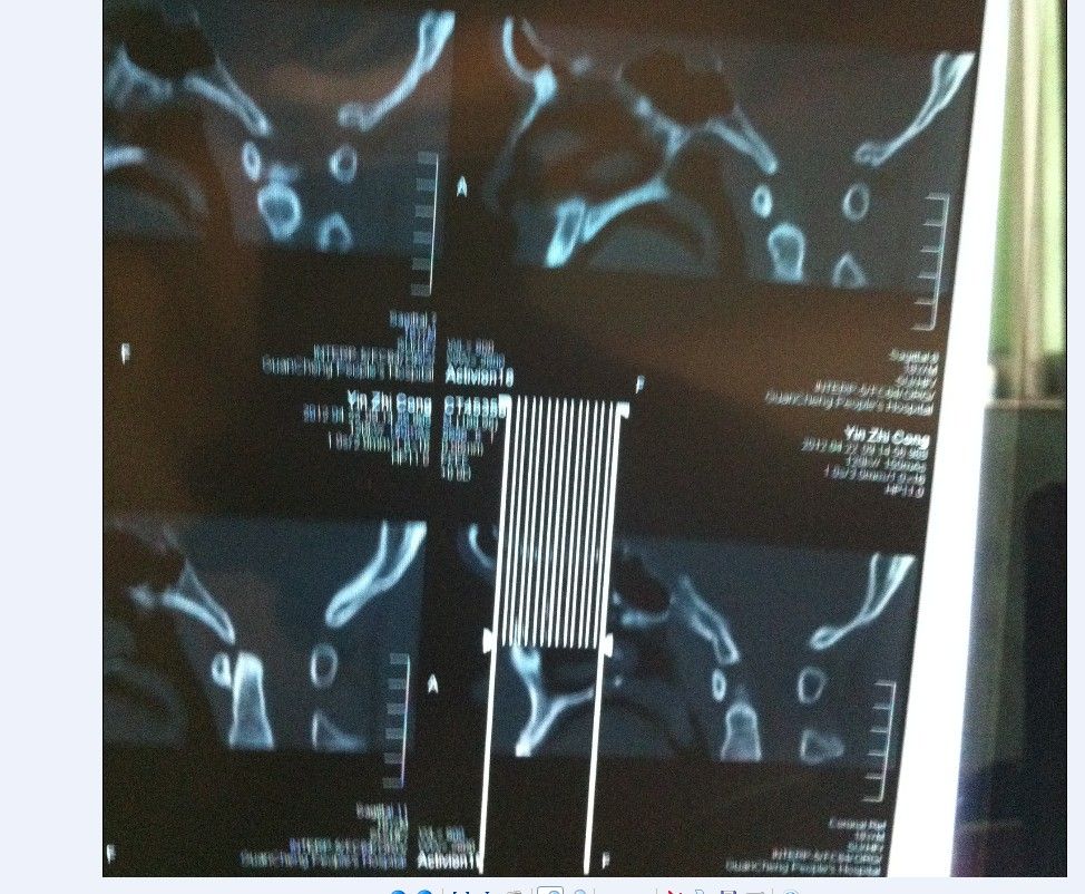 ct39022:帮忙看看ct鼻骨